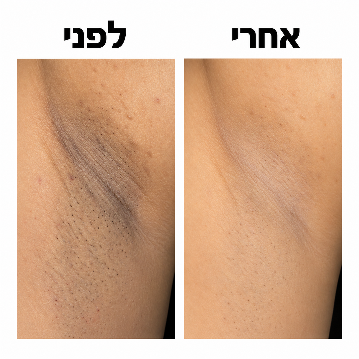 LIORA סטיק חומצה גליקולית לגוף
